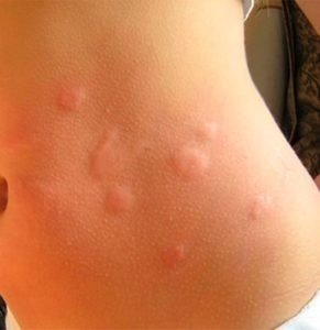 Аллергия на укусы блох